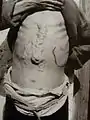 Von Schistosomiase betroffener (China)