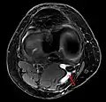 Baker-Zyste MRT axial mit Durchtrittsstelle (Pfeil) zwischen M. semimembranosus und M. gastrocnemius Caput mediale.