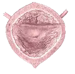 Links: Schematische Darstellung der anatomischen Verhältnisse zwischen Harnblase und Harnröhre,Rechts: Blick aus dem Inneren der Harnblase, dem Trigonum vesicae und als dem Ursprungsort der Urethra die zentral liegende Öffnung der inneren Harnröhrenmündung (Ostium urethrae internum)