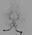 Subtraktionsangiographische Darstellung der vertebrobasilären Hirngefäße