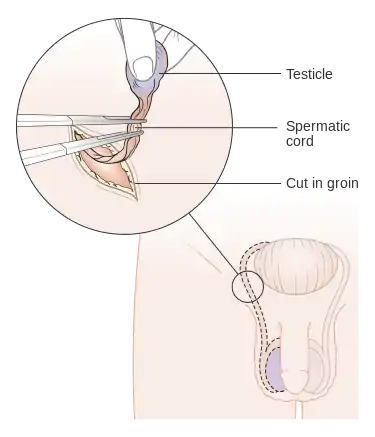 Diagram showing how the testicle is removed (orchidectomy) CRUK 141