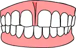 echtes Diastema