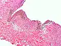 Endometriom im mikroskopischen Bild