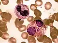 Neutrophiler Granulozyt (oben) und Eosinophiler Granulozyt