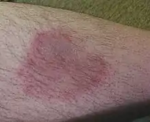 Wanderröte als Folge eines Zeckenstichs mit Borrelioseinfektion