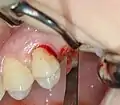 Externer Sinuslift mit Implantation Regio 26 – Kieferkammschnitt und Sulcusschnitt