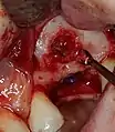 Externer Sinuslift mit Implantation Regio 26 – Knochenaufbau mit Eigenknochen