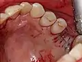 Externer Sinuslift mit Implantation Regio 26 – Vernähte Gingiva nach Abschluss