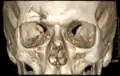 Impressionsbruch der Stirnhöhle in der Computertomographie: 3D-Rekonstruktion in Volume-Rendering-Technik.
