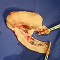 Lymphom im terminalen Ileum, das pathohistologisch als high-grade Lymphom klassifiziert wurde.