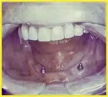 Zwei Implantate im Unterkiefer mit Patrizen zur Befestigung einer Cover-Denture-Prothese