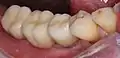 Eingesetzte Implantatbrücke auf Abutments