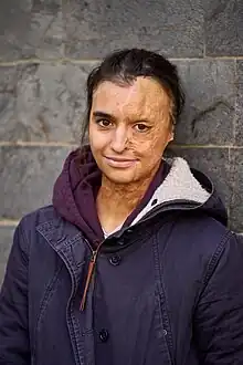 Lena Cornelissen (mit vernarbter linker Gesichtshälfte, den braunen Haaren zusammengebunden und einem leichten Lächeln) mit Winterjacke und lila Pullover, an eine Wand gelehnt. Die Sonne scheint.
