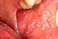 Lichen planus der Wangenschleimhaut