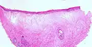 Lichen sclerosus (atrophische Form)