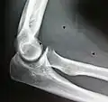 Röntgenaufnahme eines intermuskulären Lipoms im Bereich der Armbeuge. Der scharf umgrenzte, durch Pfeile gekennzeichnete, (kontrastschwache) Bereich markiert das Lipom im anterioren proximalen Unterarm.