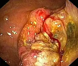 Ramucirumab