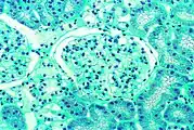 Diese lichtmikroskopische Aufnahme zeigt die Akkumulation von Gb3 in den Endothelien des Glomerulums, in den Mesangiumzellen, den Zellen im Interstitium und in den Podozyten.