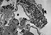 Die TEM-Aufnahme zeigt die massive elektronendichte (= schwarze) Ansammlung an Glycosphingolipiden im Lysosom der Podozyten.