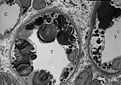 Ebenfalls eine TEM-Aufnahme. Sie zeigt die Inklusionen von Glycosphingolipiden unterschiedlicher Form und Größe in den Zellen des distalen Tubulus.