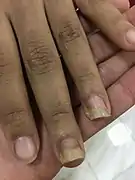 Nagelpilzbefall an Mittel- und Ringfinger