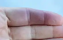 Zeigefinger mit einem blauen Hämatom