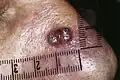 Pigmentiertes Basaliom