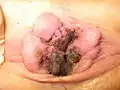 Nekrotische und thrombosierte Hämorrhoiden 4.&nbsp;Grades. In diesem Stadium ist eine Heilung nur durch eine Hämorrhoidektomie möglich.