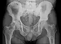 Röntgenaufnahme des Beckens eines Patienten mit Prostatakarzinom: Multiple osteoplastische Knochenmetastasen, insbesondere im Kreuzbein, aber auch im Darmbein, vor allem links (also rechts im Bild), am Sitzbeinhöcker links und im proximalen Oberschenkelknochen links. Nebenbefundlich zeigt sich eine Hüftgelenksarthrose rechts (also links im Bild).