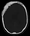 Axiale Computertomografie einer osteoplastischen Metastase im Schädelknochen eines Patienten mit Prostatakarzinom. Deutlich ist die Ausdehnung der Metastase über die ursprünglichen Knochengrenzen hinaus zu erkennen.