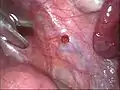 Roter Endometrioseherd