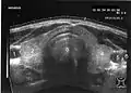 Abb. 3Ultraschallbild: Schilddrüse im Querschnitt