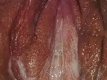 Vaginaler Ausfluss bei Gonorrhoe.
