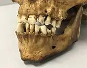 Gebiss von Theo dem Pfeifenraucher mit seinen charakteristischen Zahnlücken. Naturhistorisches Museum Basel