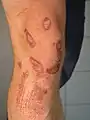 Kreisrunde Schürfwunde am Knie