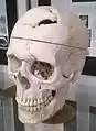 Schädel von Gage, ausgestellt im Warren Anatomical Museum der Harvard Medical School