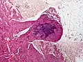 Maligne Form eines Blauen Nävus. Alle histologische Präparate sind durch Hämatoxylin-Eosin-Färbung diskriminiert.