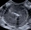Vollständig von einem Lymphom infiltrierte Darmwand. Die normale Schichtung ist vollständig verschwunden.