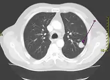Derselbe Tumor in der Computertomografie (axiales Schnittbild)