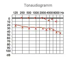 Schallleitungsschwerhörigkeit im Tonaudiogramm des rechten Ohres („rote“ Linien; im Vergleich zum linken Ohr „blaue“ Linien)<: Knochenleitung, linksX: LuftleitungDie Differenz zwischen Luftleitungs- und Knochenleitungsaudiogramm ist typisch für eine Schallleitungsschwerhörigkeit