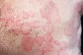 Auf dem Rücken der linken Mittelhand
