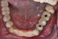 Verschraubte Implantatbrücke auf Unterkiefer-Implantaten