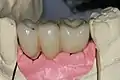 Verschraubte Implantatbrücke auf dem Modell