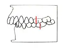 Angle-Klasse II/1