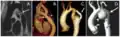 Koarktation der Aorta mit verschiedenen bildgebenden Verfahren: A – Enge Koarktation am Aortenisthmus (Pfeil) B – Kontrastverstärktes 3D-CT-Angiogramm mit einem leicht verengten Bare-Metal-Stent (Pfeil), der teilweise den Ursprung der linken Arteria subclavia bedeckt. Die Pfeilspitze zeigt ein subtiles Pseudoaneurysma am distalenEnde des Stents. C – Kontrastverstärktes 3D-Angiogramm mit Aortenbogenhypoplasie und Koarktation mit posteriorem Bypass-Transplantat (Pfeil) D – MR 3D-kontrastverstärktes Angiogramm mit großem Pseudoaneurysma (Pfeilspitze) nach vorheriger plastischer Operation Angioplastie. Auf der Rückseite ist echtes Licht zu sehen (Pfeil)